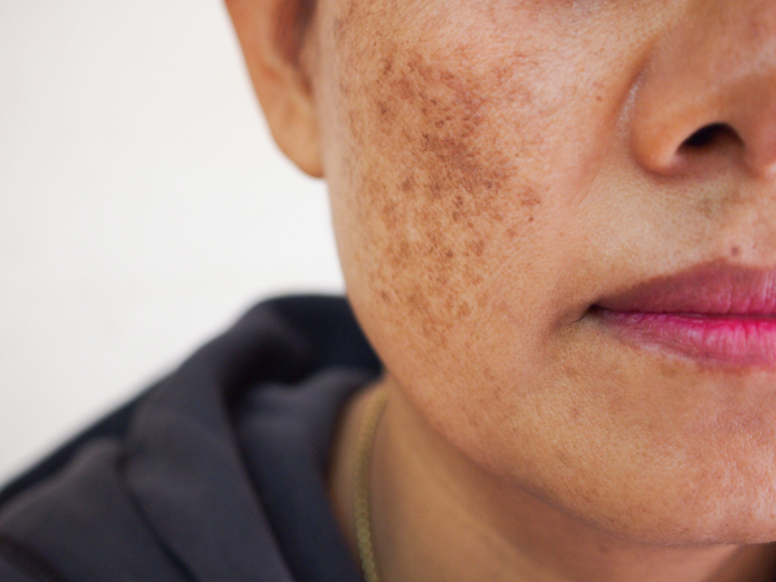 Top 10 Effective Treatments for Hyperpigmentation in Northbrook, IL